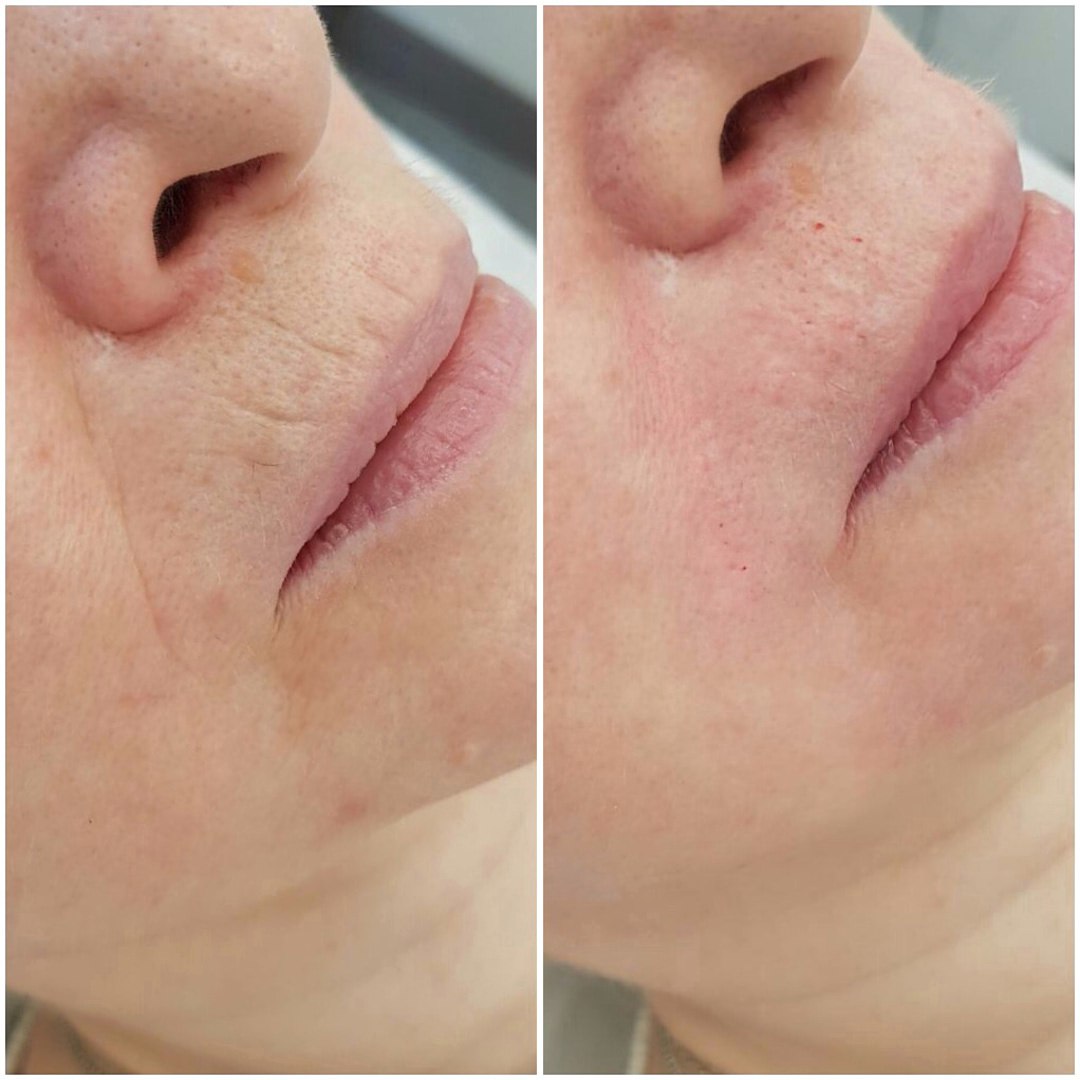 коррекция кисетных морщин