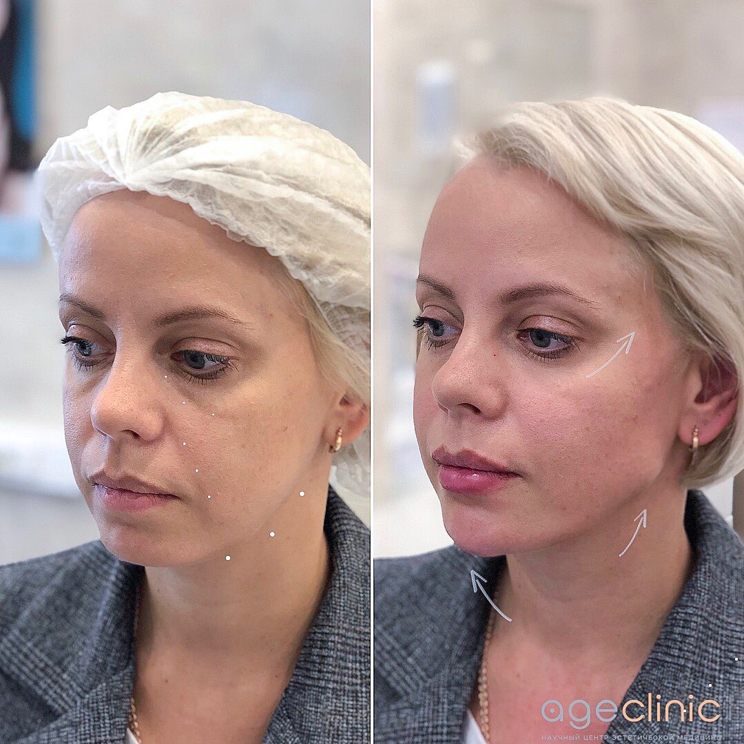 радиесс коррекция