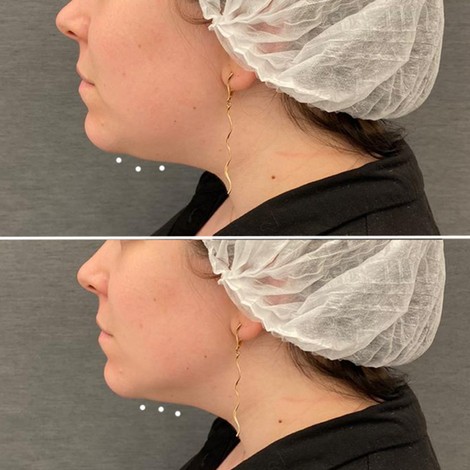 ультраформер второй подбородок