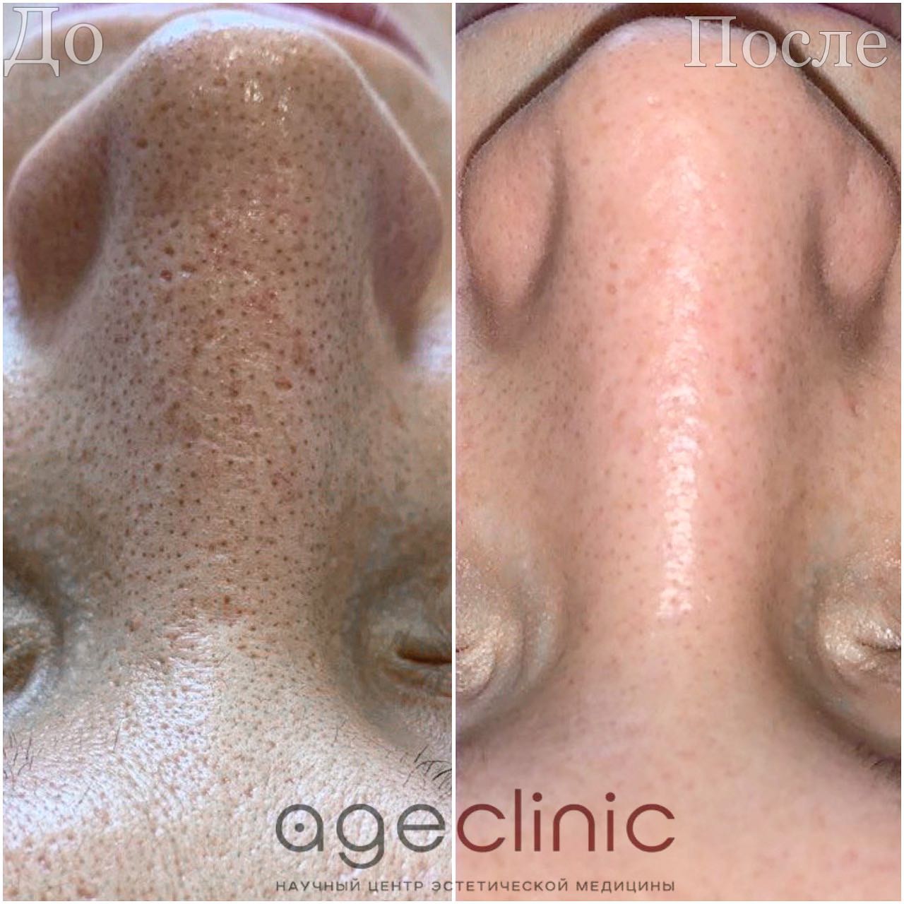 Коррекция мужского лица на аппарате Ультраформер