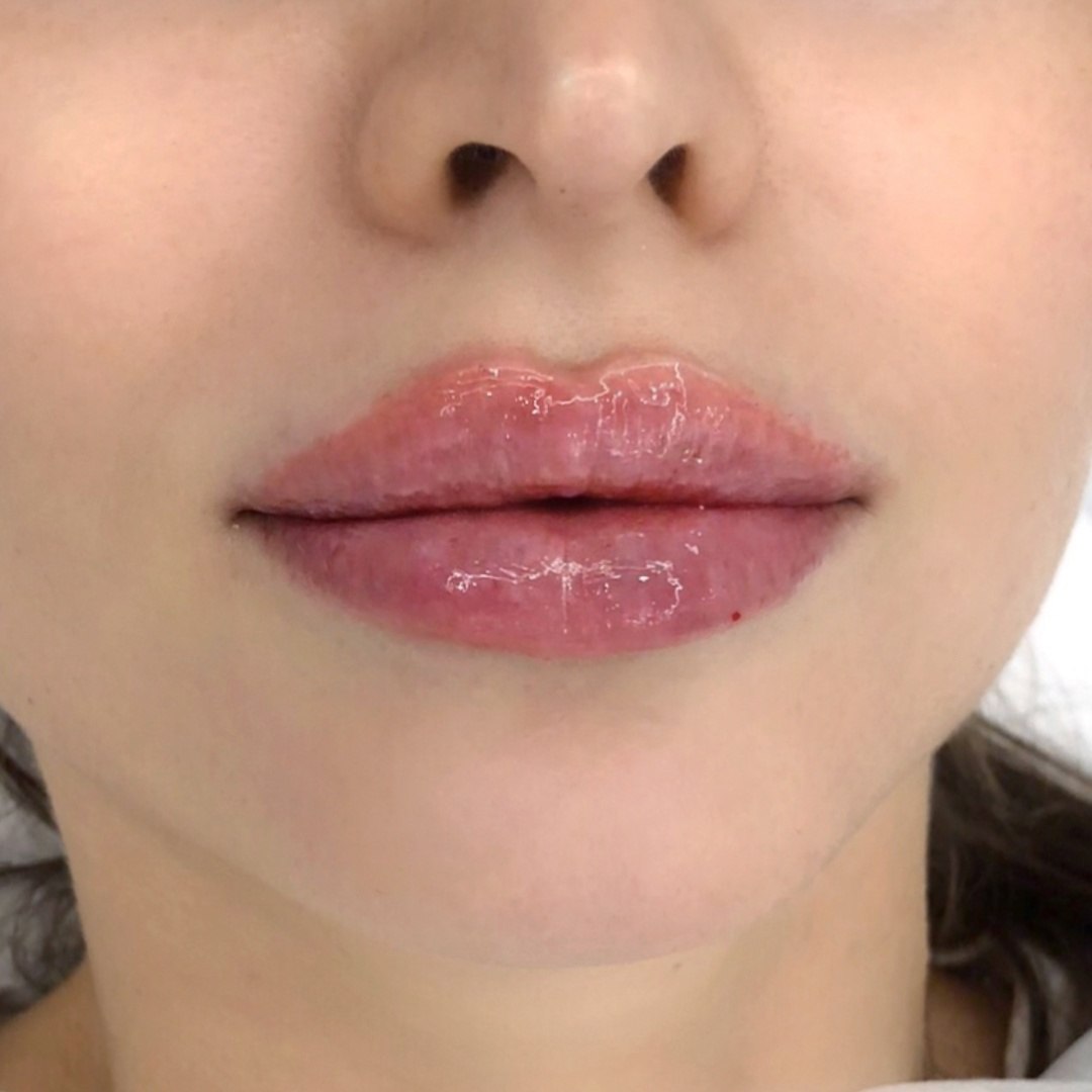 Филлеры для губ | Увеличение губ филлером в Москве | Age Clinic