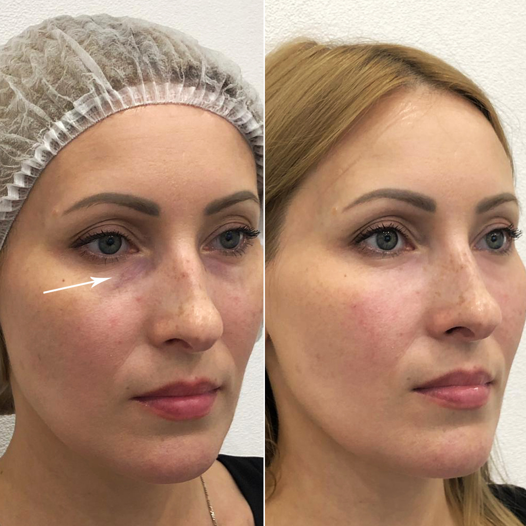 Коррекция носослезной борозды – фотографии до и после