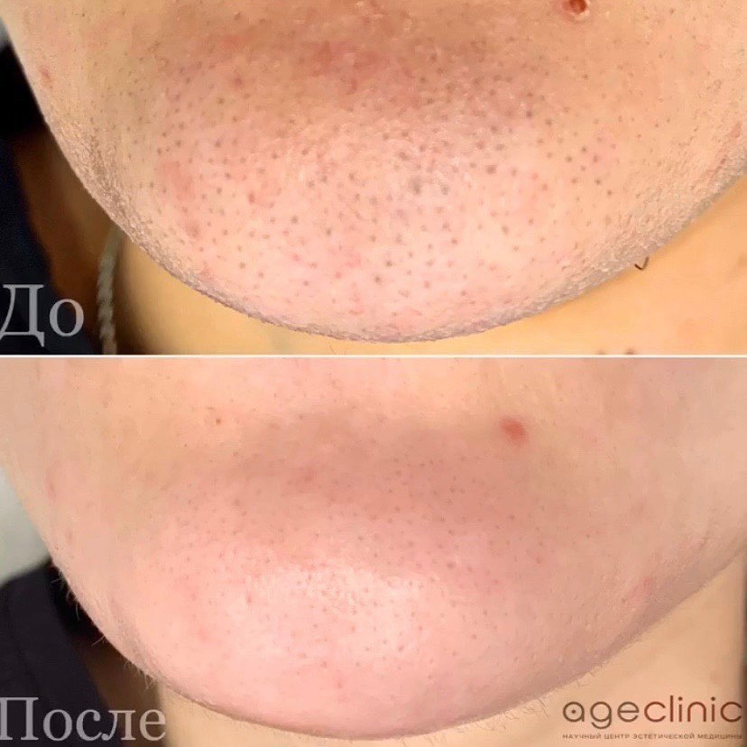 Коррекция углов челюсти и подбородка