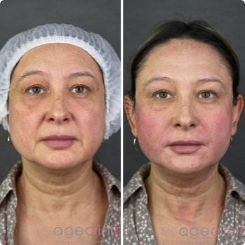 До и после аппаратная коррекция лица