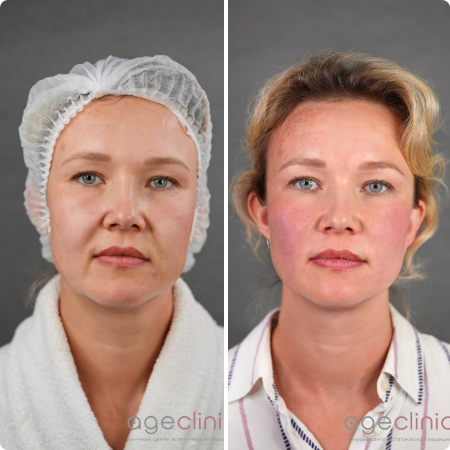 До и после СМАС лифтинг лица
