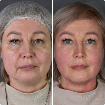 До и после SMAS лифтинг лица