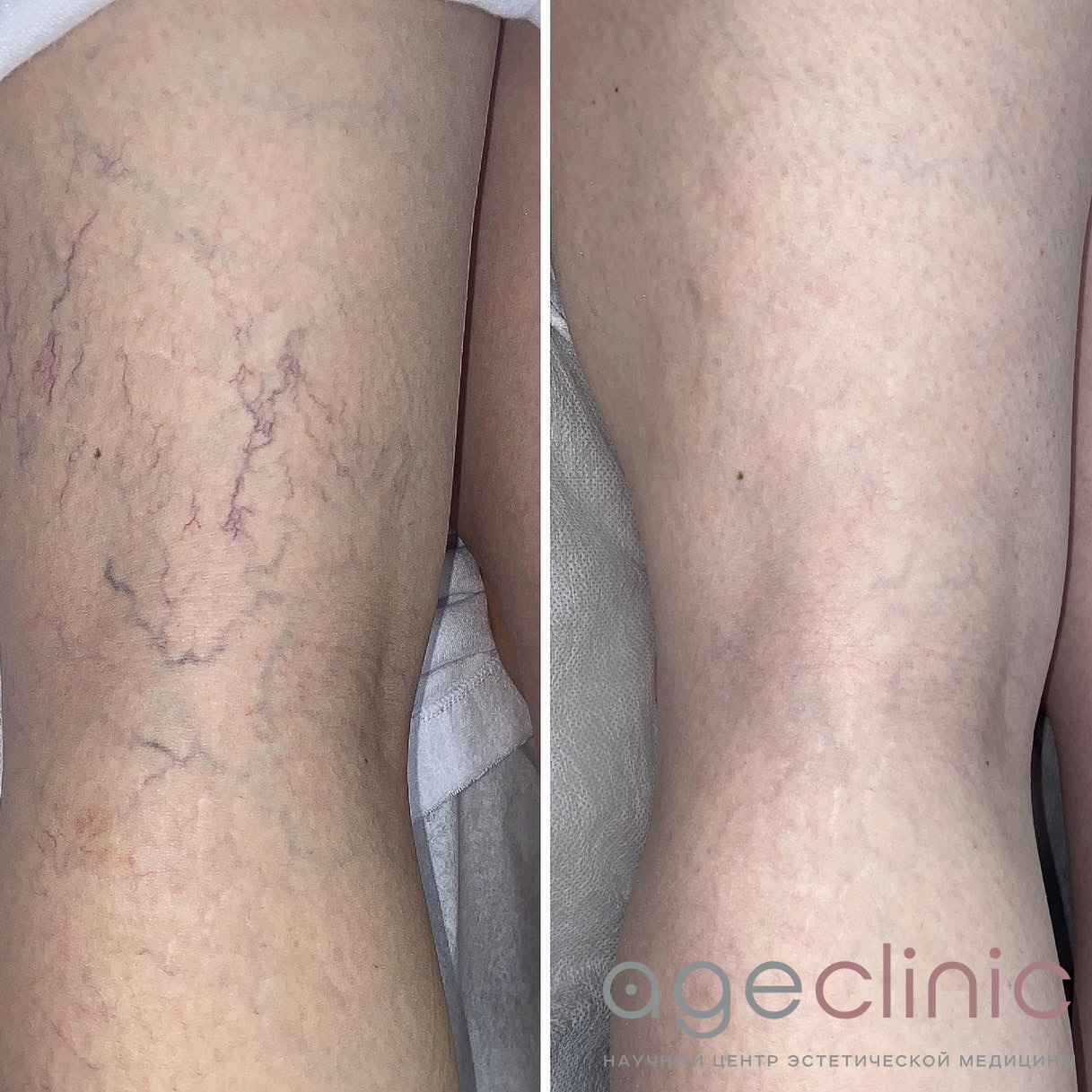 До и после СМАС лифтинга ног