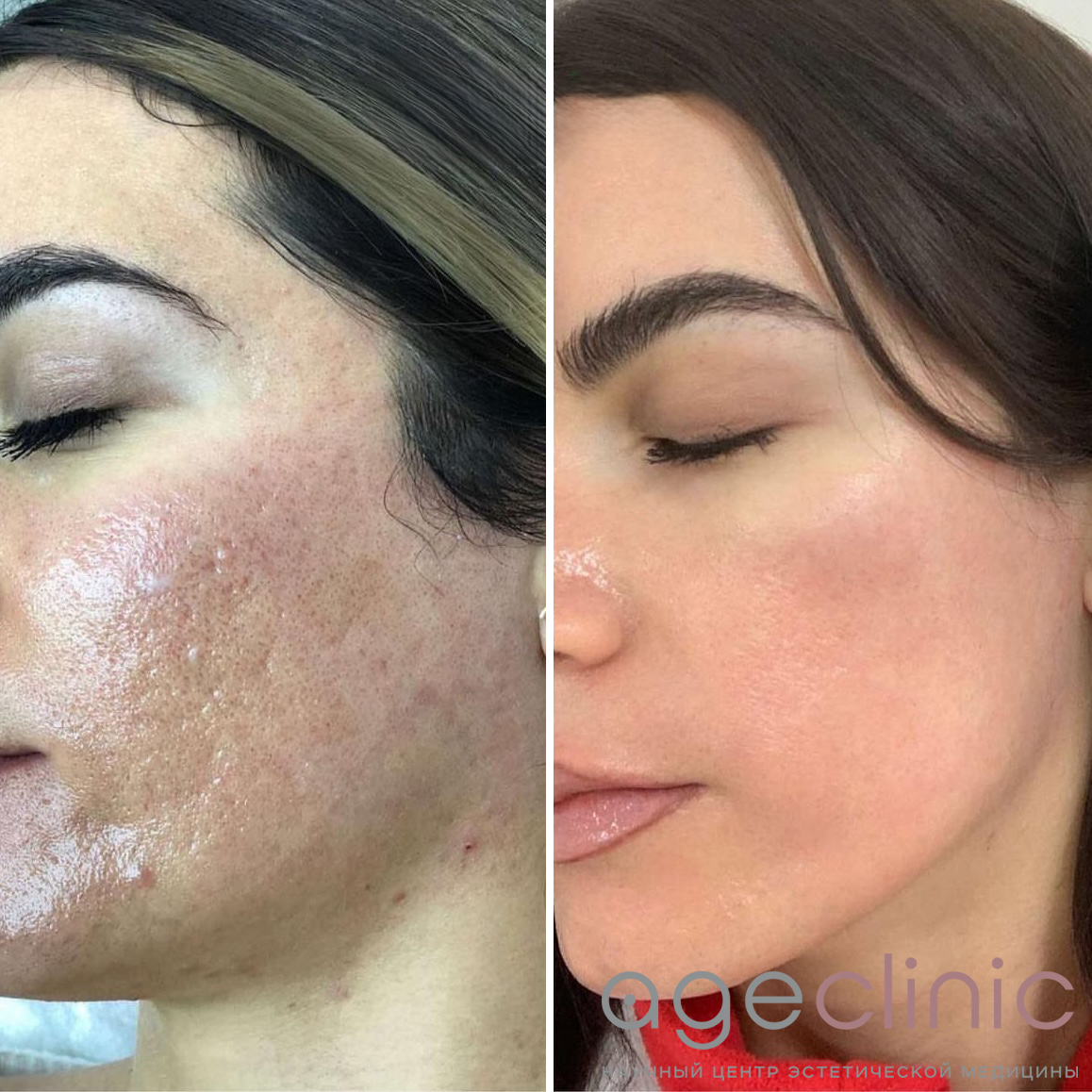 До и после аппаратной коррекции лица