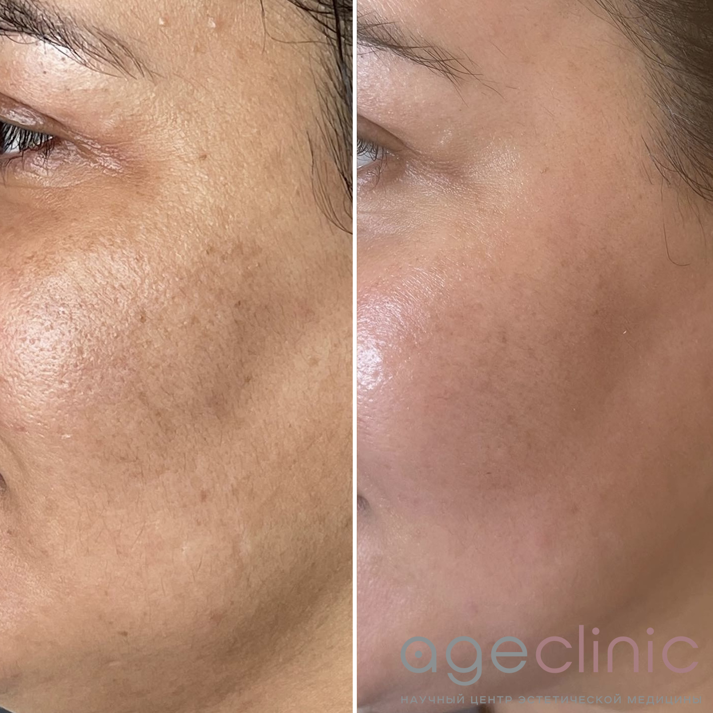 До и после SMAS лица