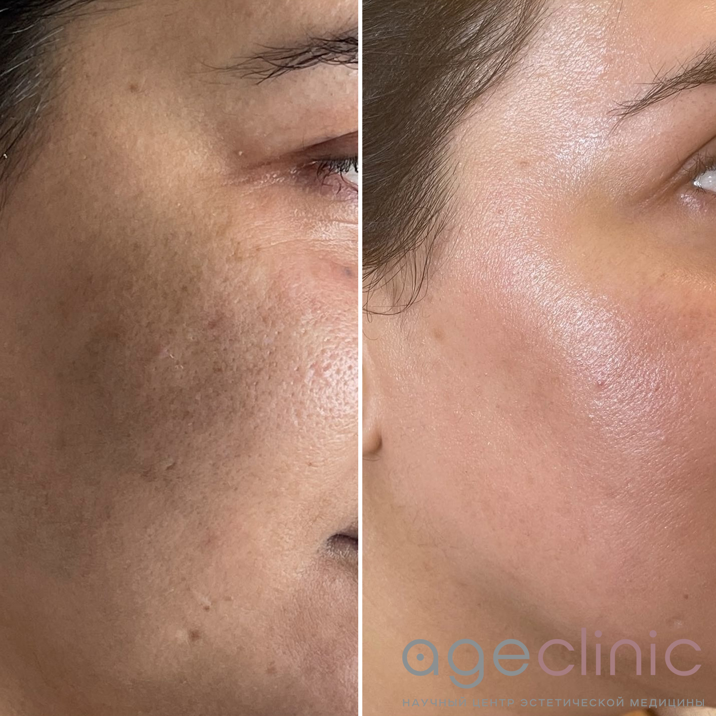 До и после СМАС лица