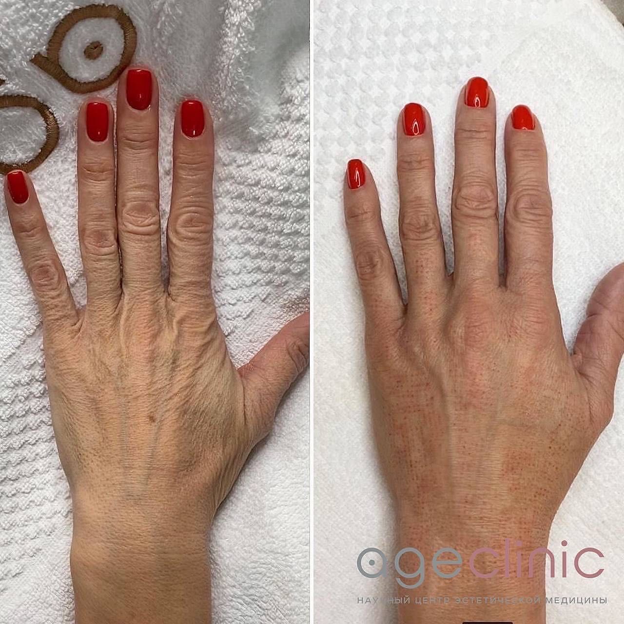 До и после аппаратная коррекция рук