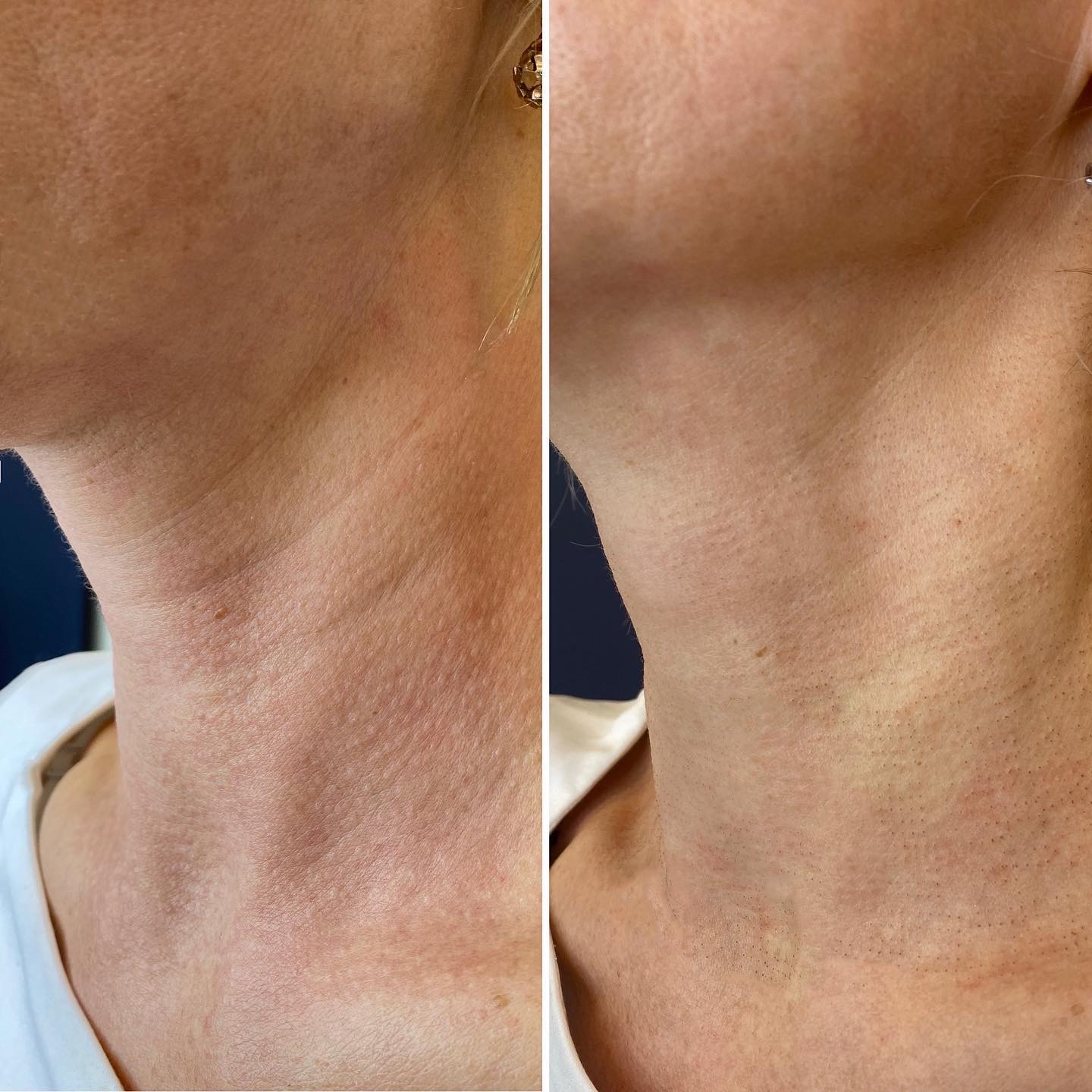 До и после лифтинг подтяжка шеи