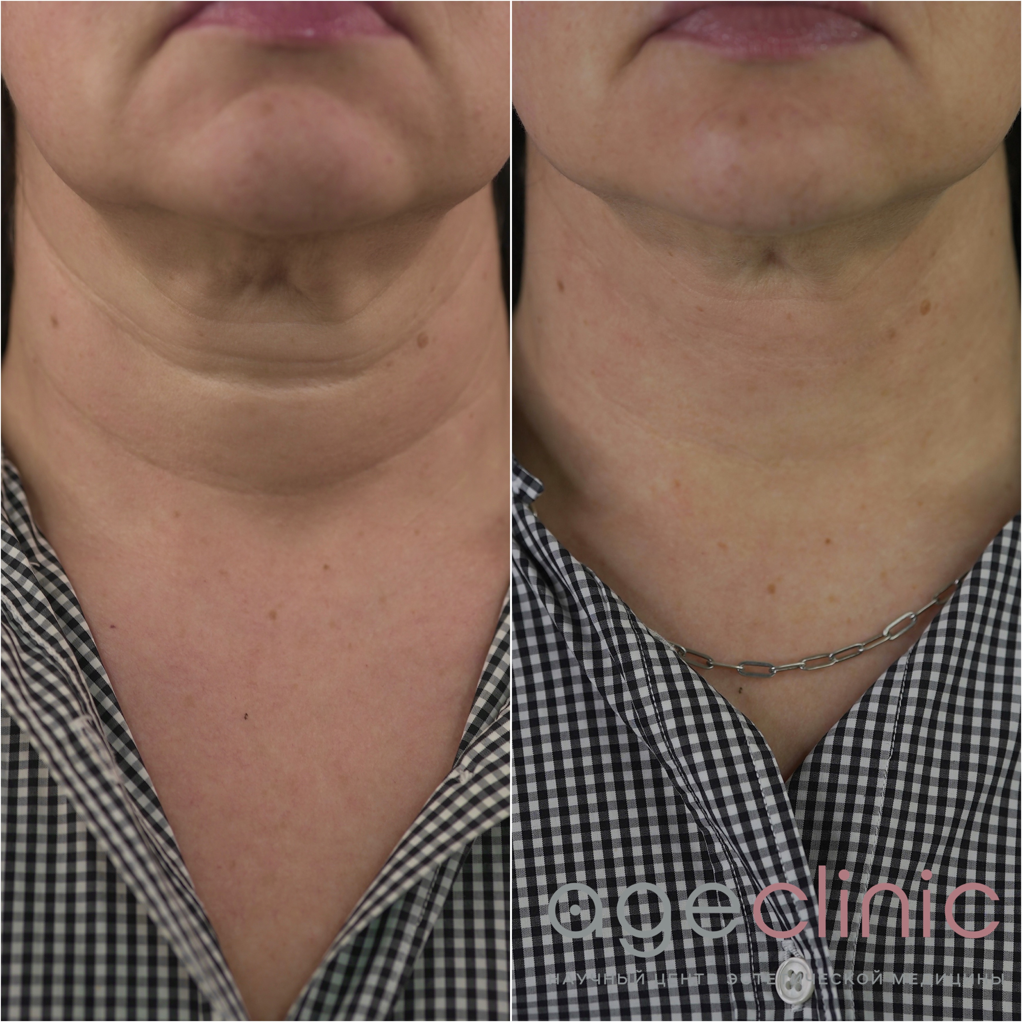 До и после аппаратная подтяжка шеи