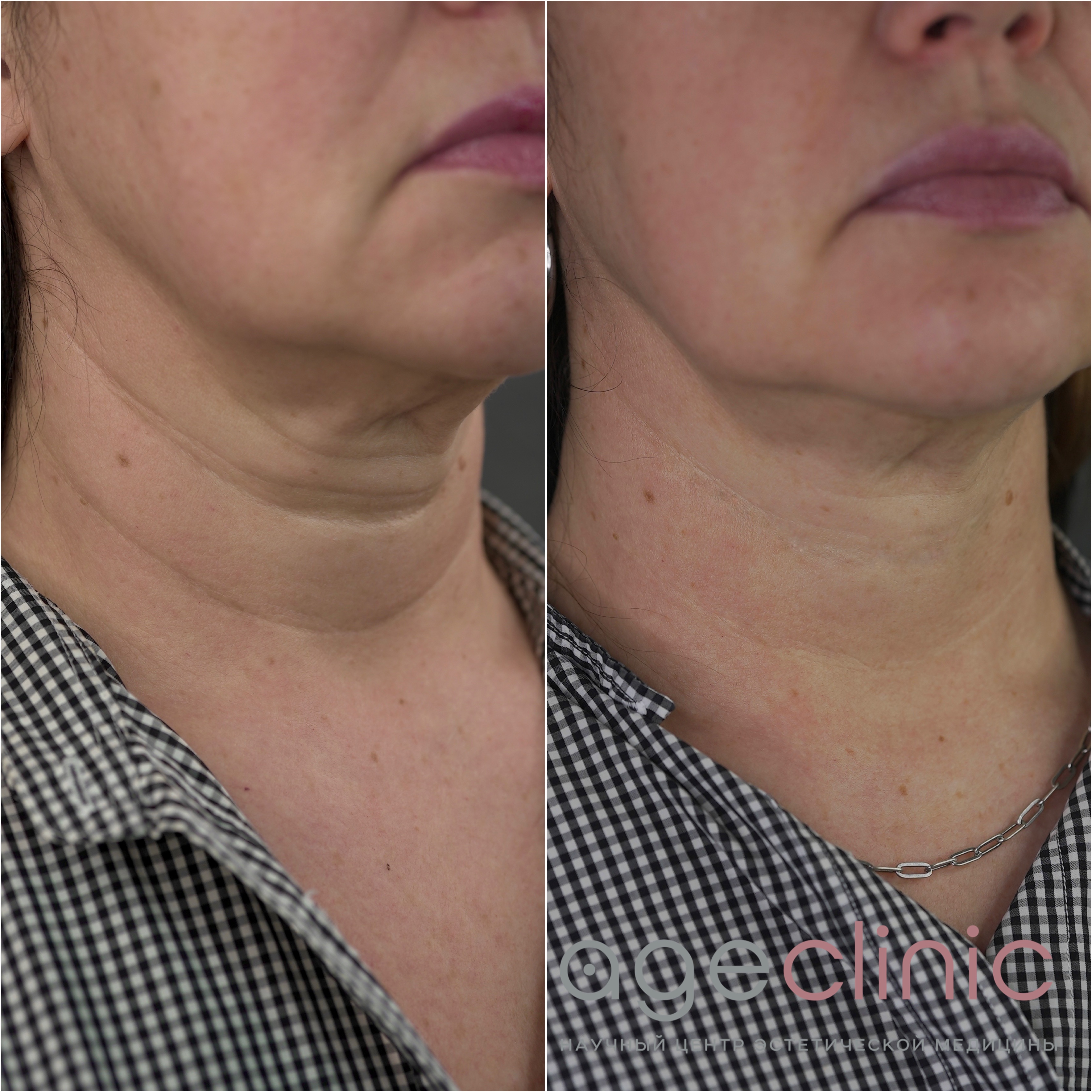До и после ультразвуковая подтяжка шеи