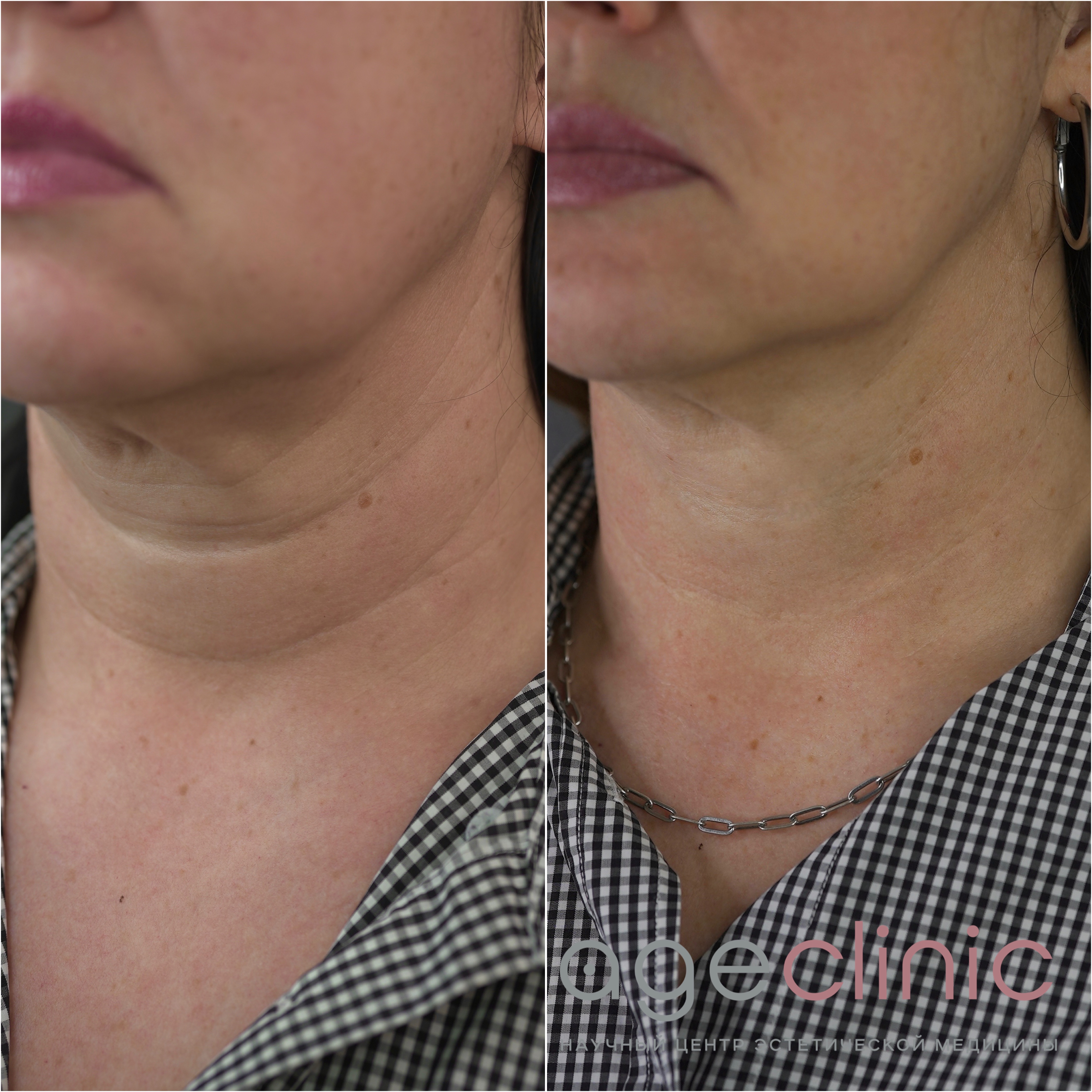 До и после ультразвуковой лифтинг шеи