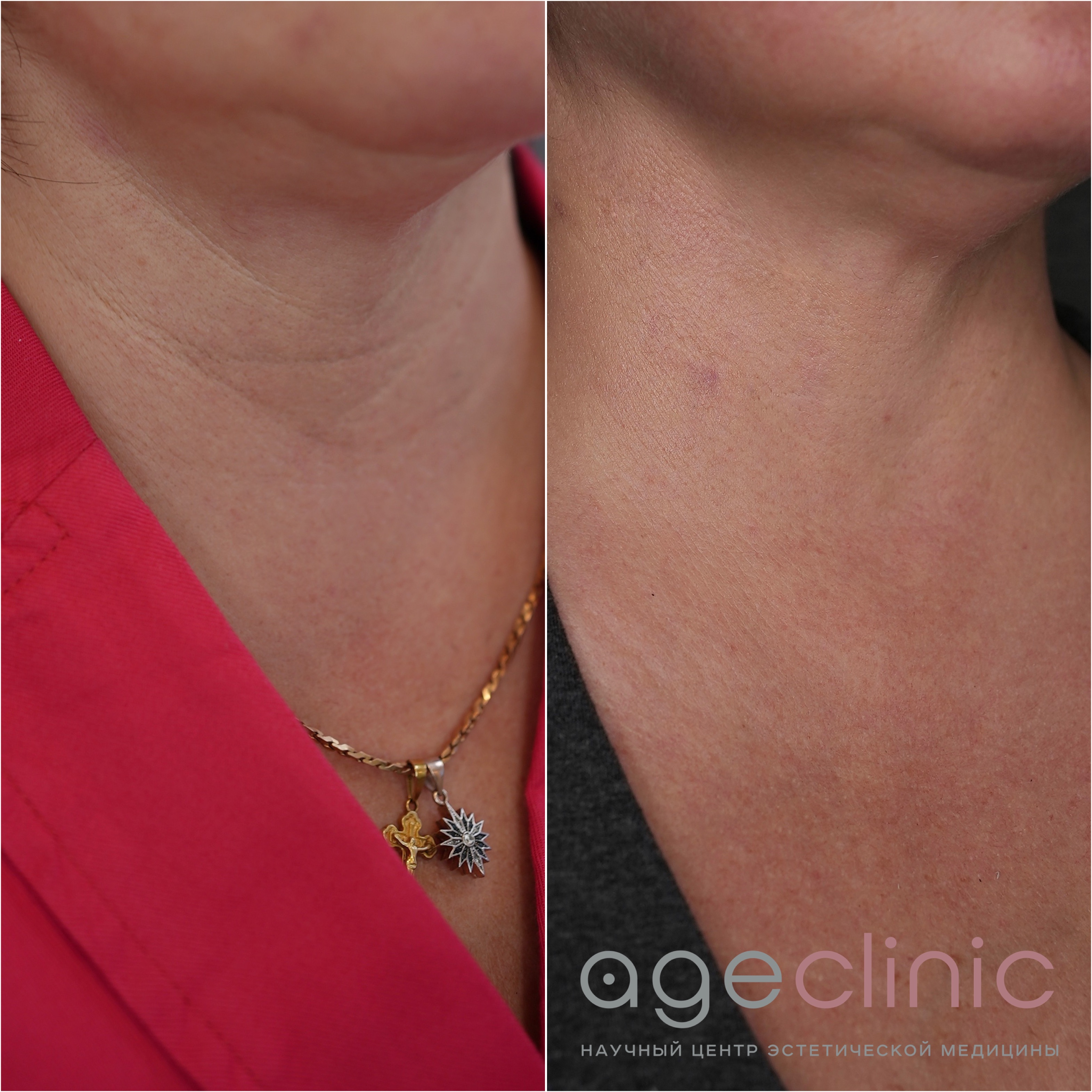 До и после SMAS лифтинга