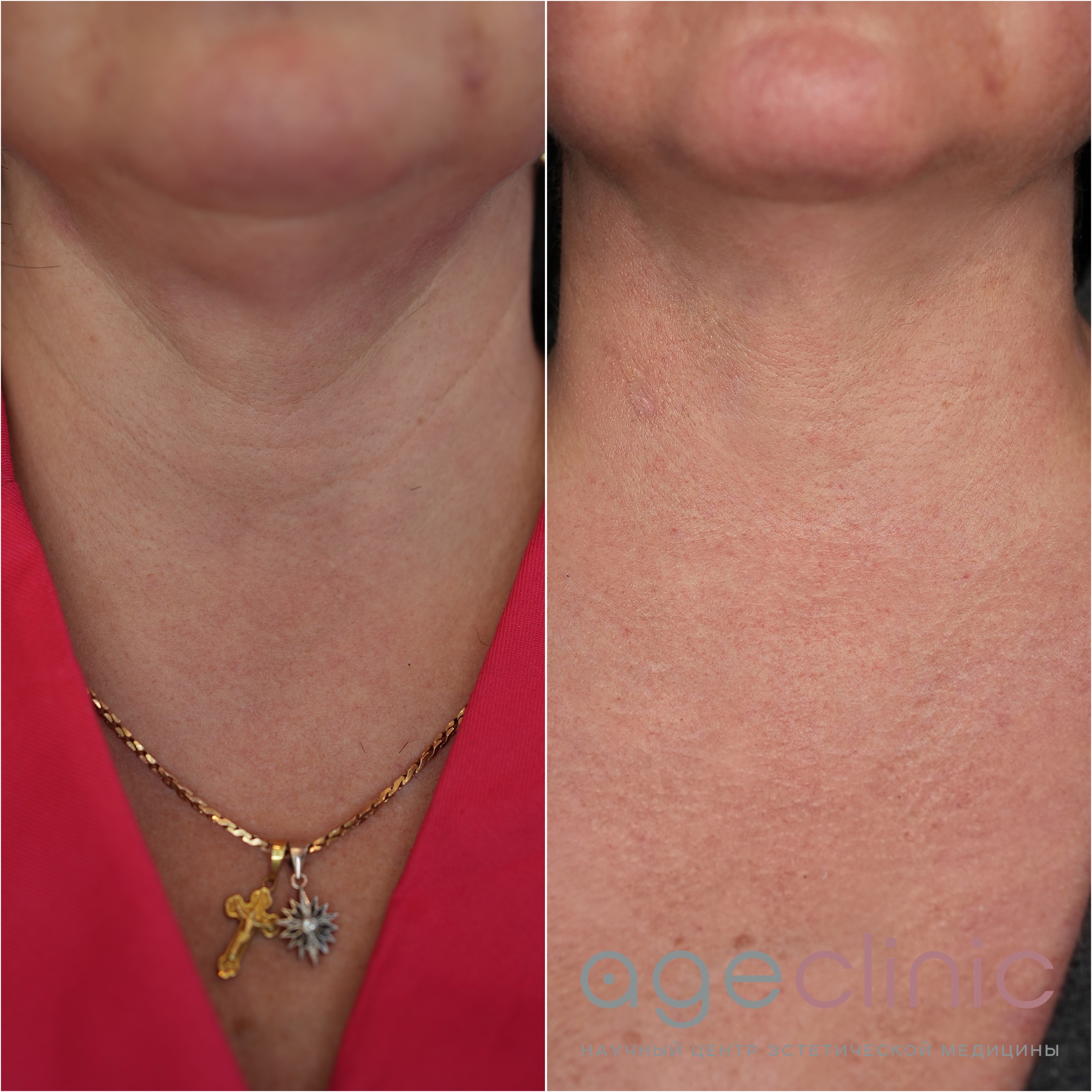 До и после СМАС лифтинга