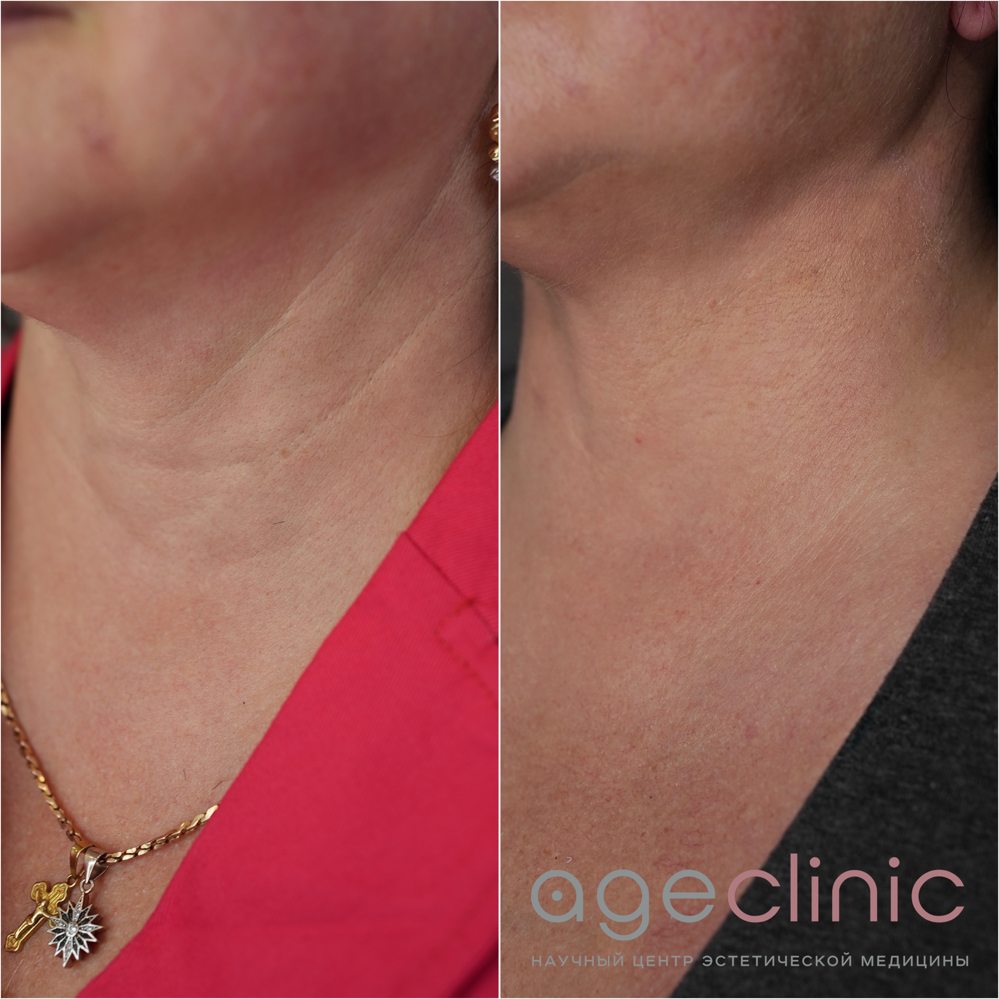 До и после аппаратной коррекции