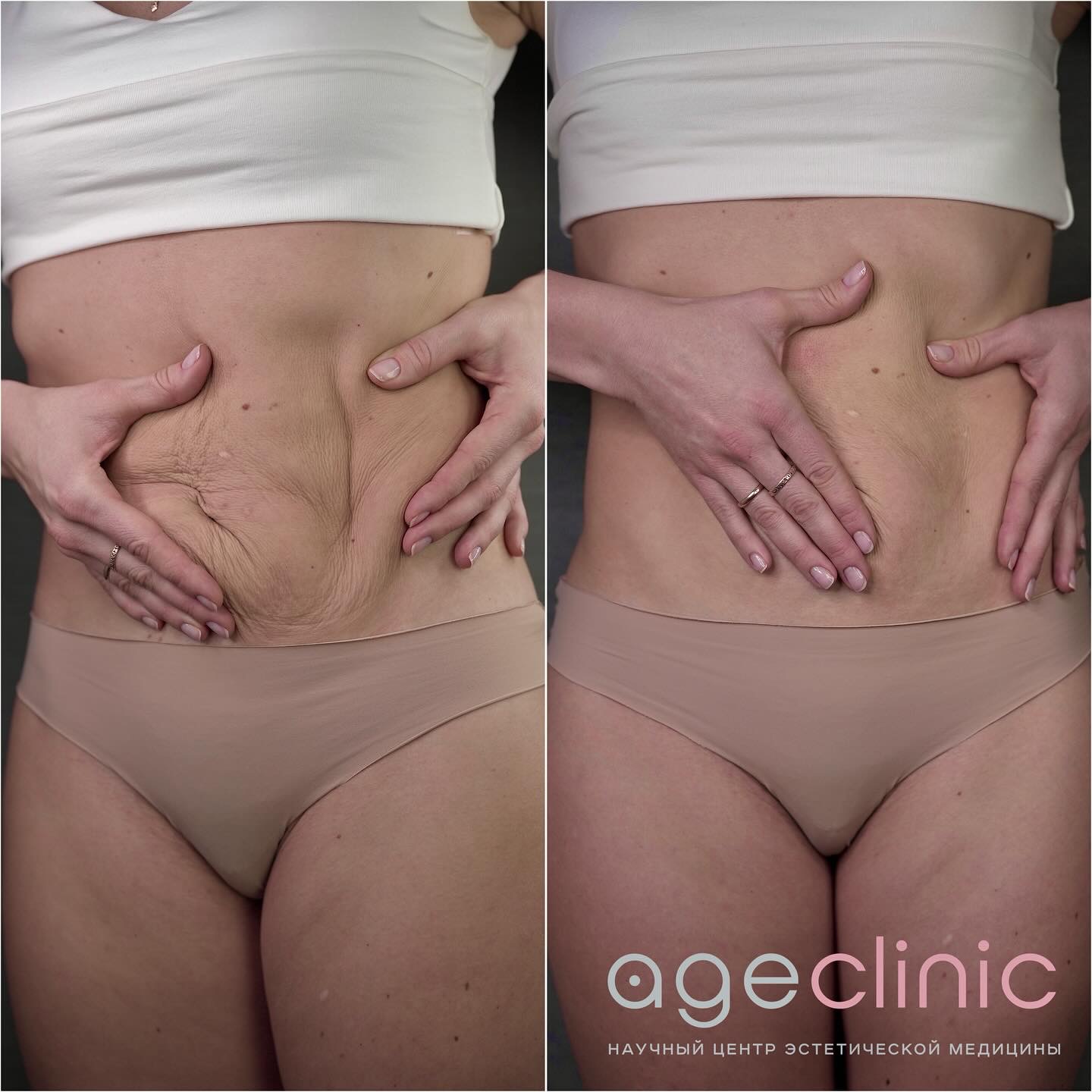До и после SMAS лифтинга живота