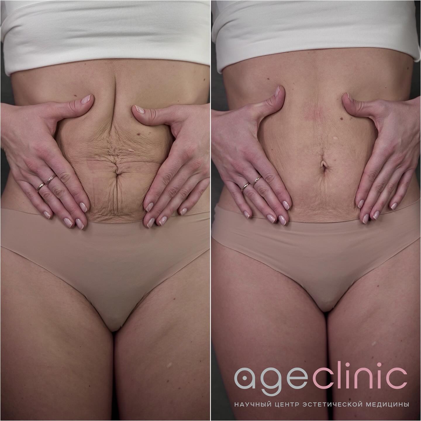 До и после СМАС лифтинга живота