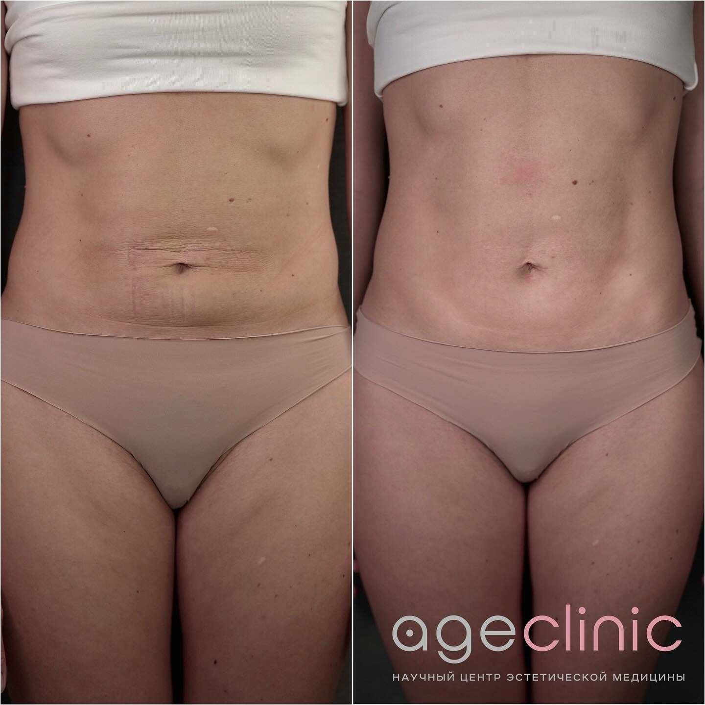 До и после аппаратная коррекция живота