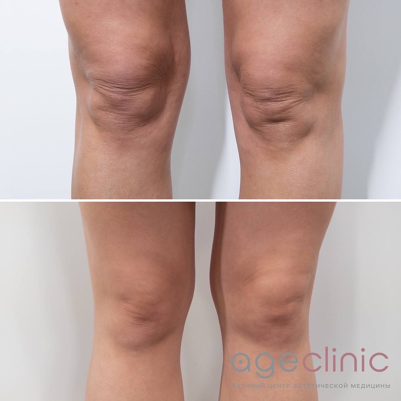 До и после аппаратная коррекция коленей