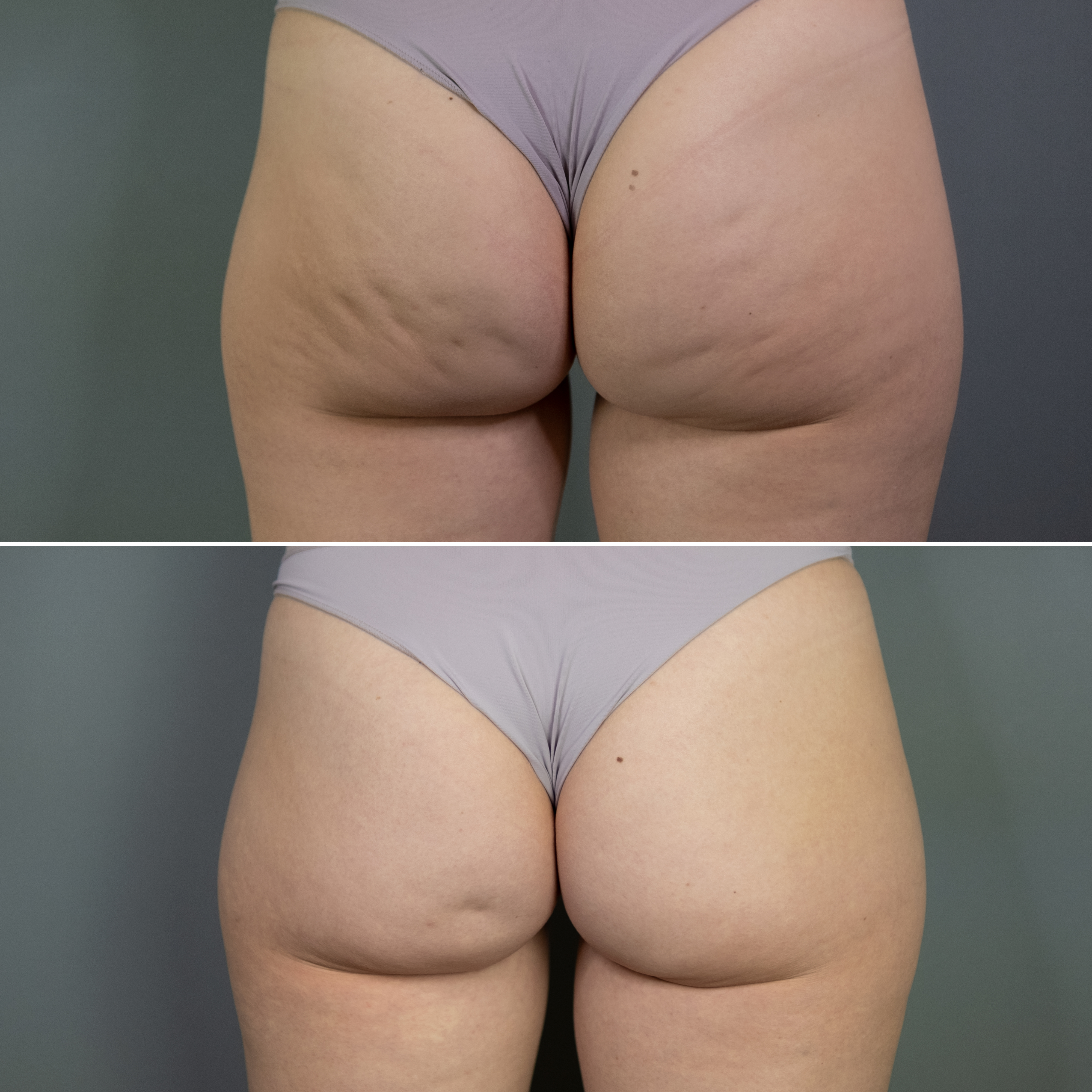 До и после ультразвуковая подтяжка ягодиц