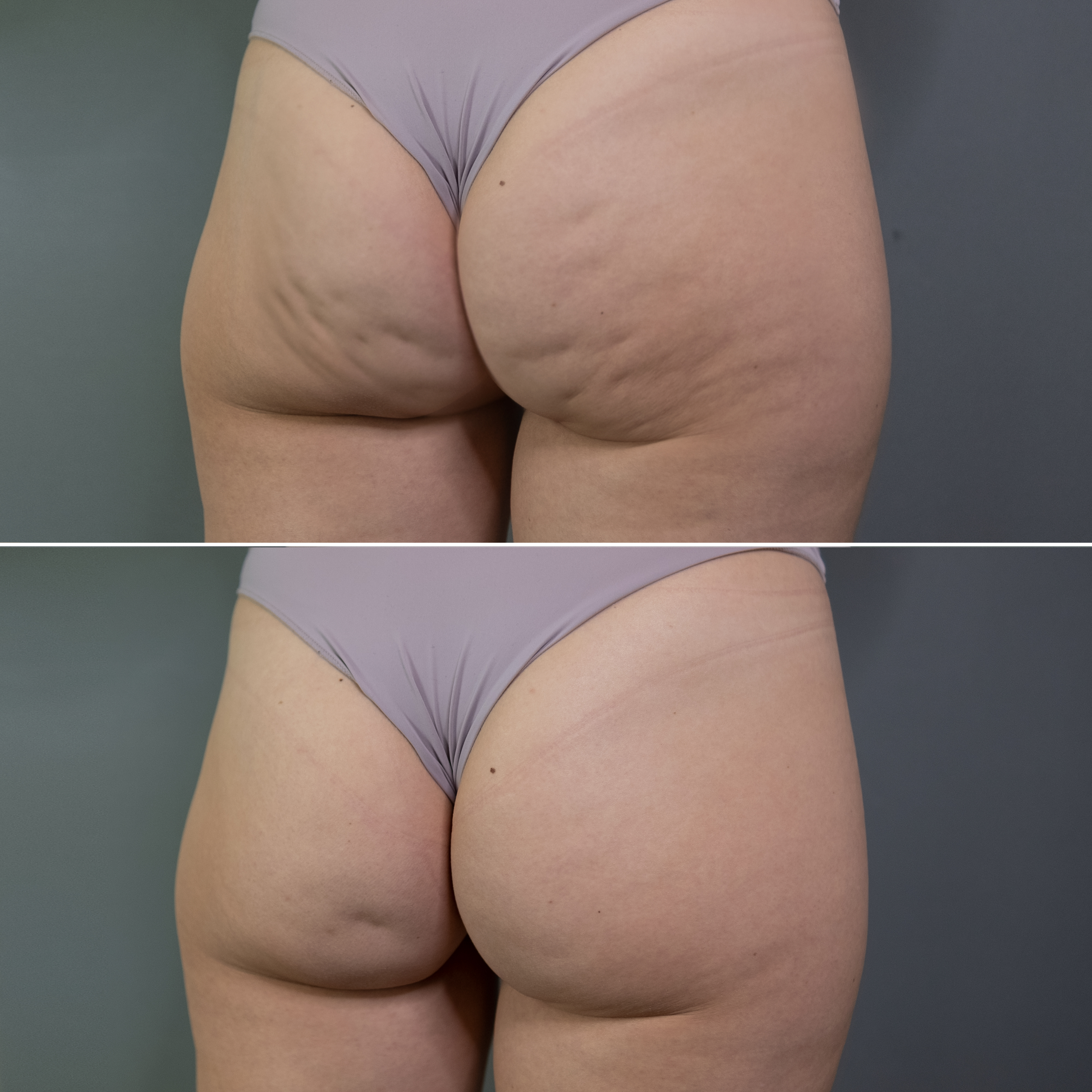 До и после SMAS лифтинга ягодиц